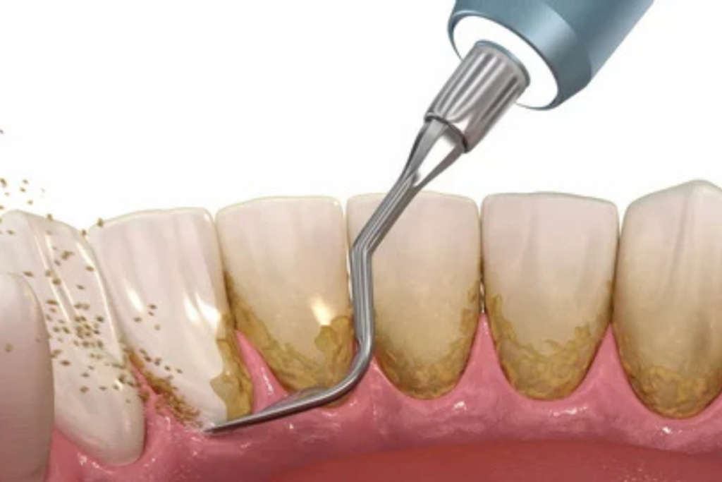 Teeth Cleaning & Scaling